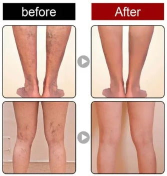 VenaFree Plus ¡Última oportunidad! Oferta por tiempo limitado: Obtenga el tratamiento completo y devuelva la salud a sus piernas sin cirugías ni procedimientos dolorosos.